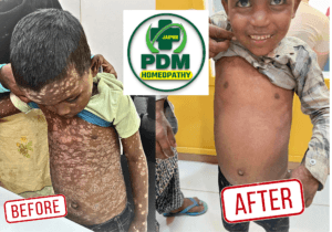 Psoriasis Treatment at PDM Homeopathy Hospital