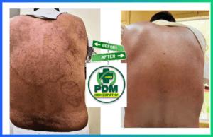 Ringworm Treatment - PDM Homeopathy Hospital